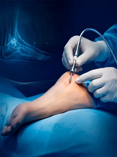 Cirurgia percutânea minimamente invasiva no pé, com instrumento cirúrgico e radiografia do tornozelo ao fundo, com o Dr. Diego Meneghel — ortopedista de pé e tornozelo em Florianópolis e Tubarão