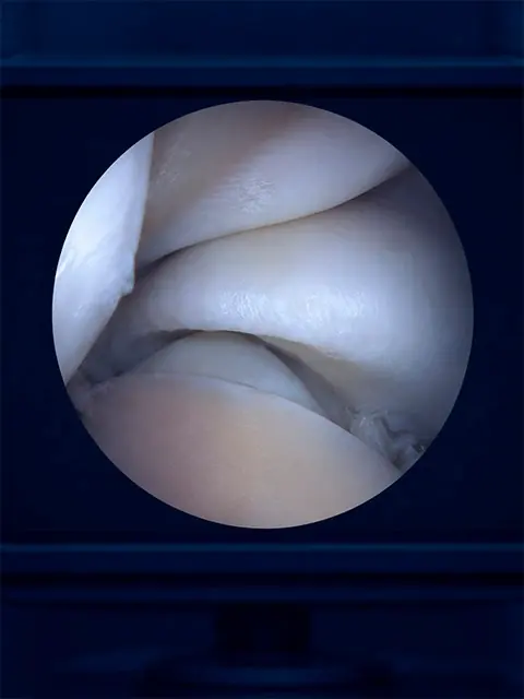 Videoartroscopia do tornozelo realizada em ambiente cirúrgico, com o Dr. Diego Meneghel — ortopedista de pé e tornozelo em Florianópolis e Tubarão